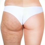 Cellulite legs before and after